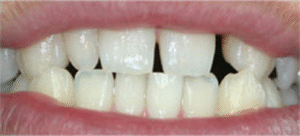 審美歯科｜治療前｜船津歯科クリニック｜佐賀