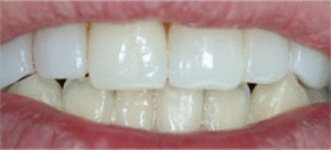 審美歯科｜治療後｜船津歯科クリニック｜佐賀