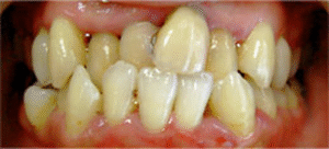 審美歯科｜治療前｜船津歯科クリニック｜佐賀