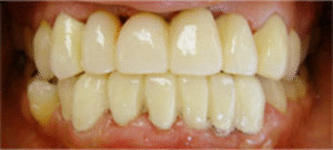 審美歯科｜治療後｜船津歯科クリニック｜佐賀