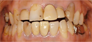 審美歯科｜治療前｜船津歯科クリニック｜佐賀