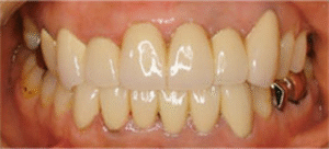 審美歯科｜治療後｜船津歯科クリニック｜佐賀