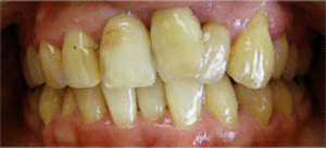 審美歯科｜治療前｜船津歯科クリニック｜佐賀