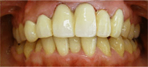 審美歯科｜治療後｜船津歯科クリニック｜佐賀