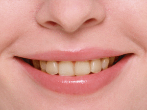 審美歯科｜ホワイトニング｜施術前｜船津歯科クリニック｜佐賀