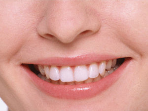 審美歯科｜ホワイトニング｜施術後｜船津歯科クリニック｜佐賀