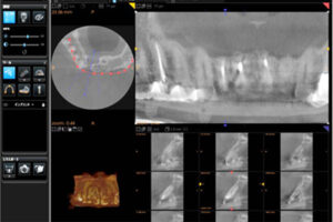 インプラント｜ＣＴ撮影｜船津歯科クリニック｜佐賀