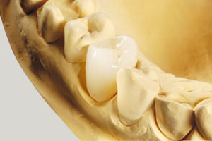 セレック｜CEREC｜セラミック治療｜船津歯科クリニック｜佐賀