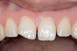 セラミック治療｜治療前｜船津歯科クリニック｜佐賀