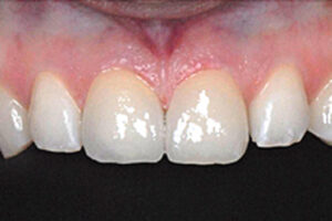 セラミック治療｜治療後｜船津歯科クリニック｜佐賀