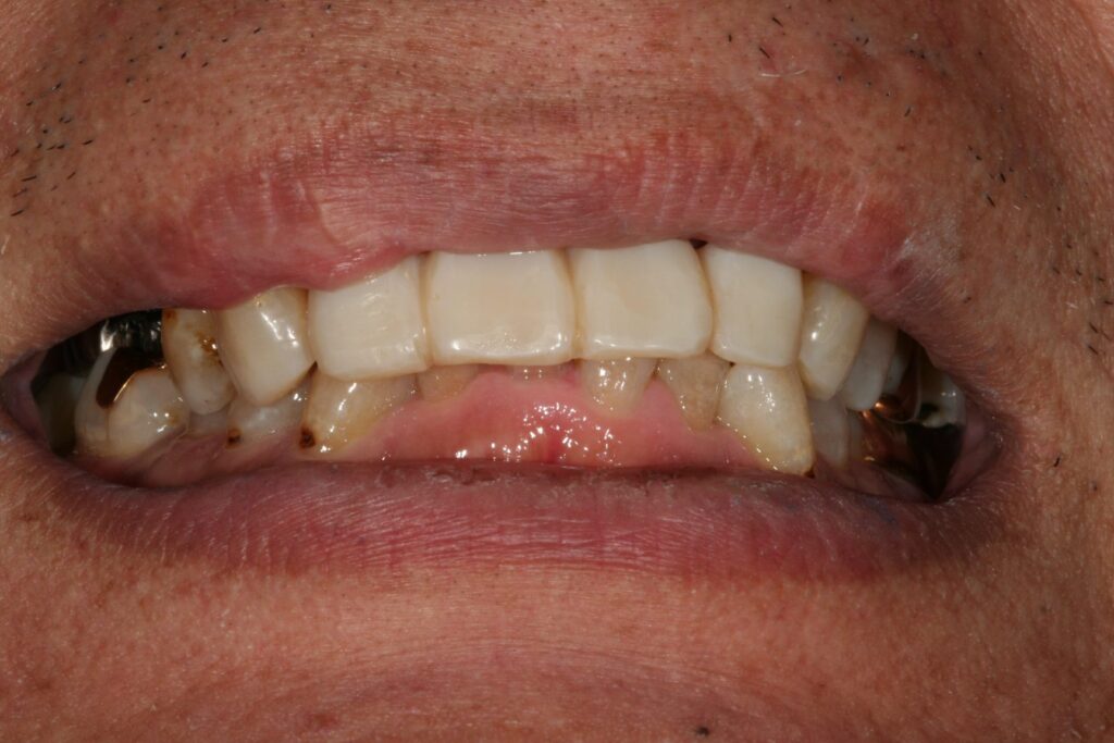 症例紹介｜審美歯科｜佐賀｜船津歯科クリニック