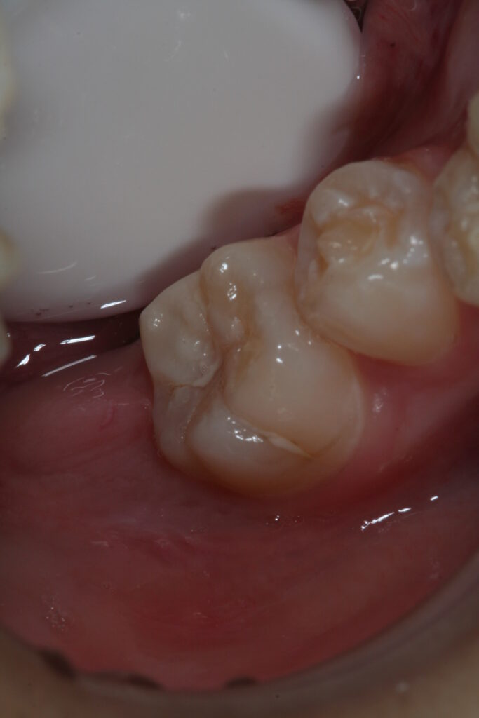 症例紹介｜虫歯治療｜佐賀｜船津歯科クリニック
