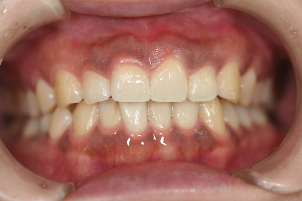 症例紹介｜審美歯科｜佐賀｜船津歯科クリニック