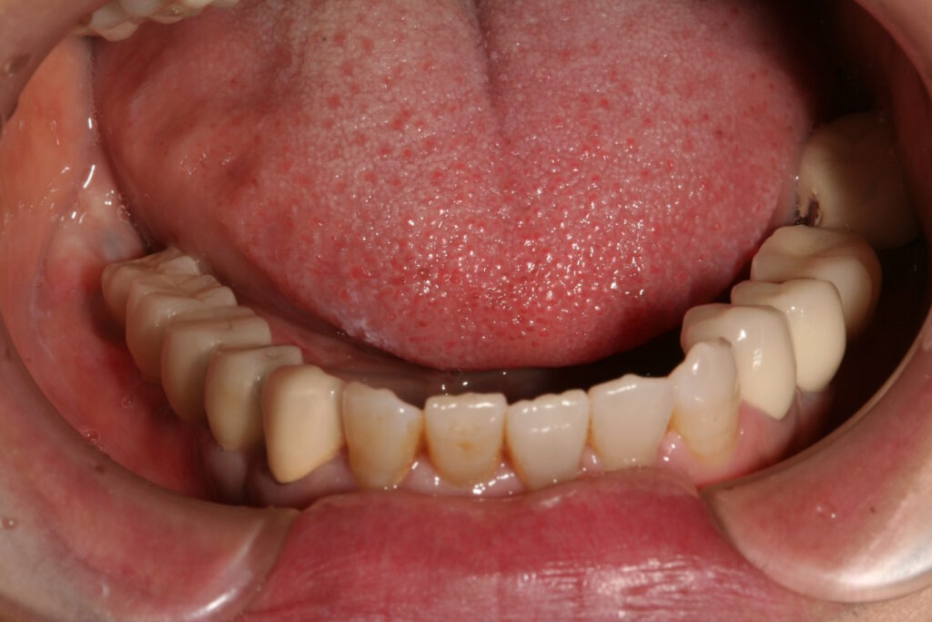 症例紹介｜インプラント｜佐賀｜船津歯科クリニック