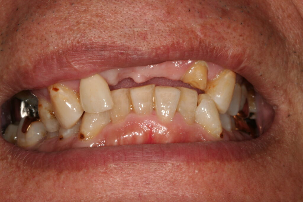 症例紹介｜審美歯科｜佐賀｜船津歯科クリニック