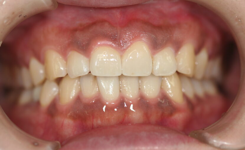 症例紹介｜審美歯科｜佐賀｜船津歯科クリニック