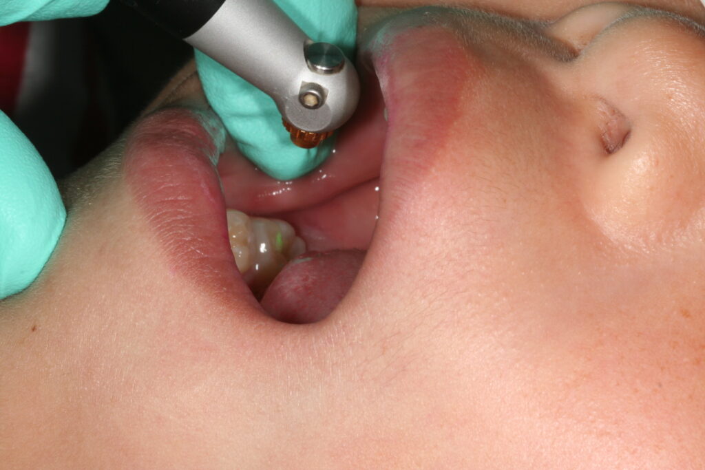 症例紹介｜虫歯治療｜佐賀｜船津歯科クリニック