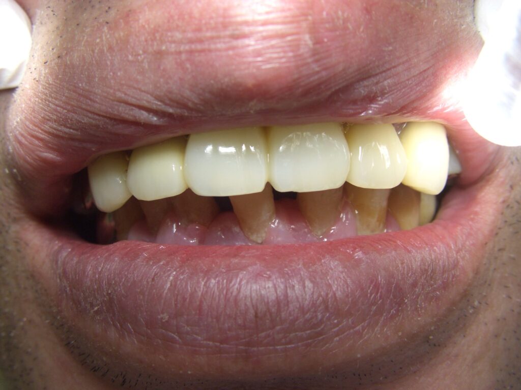 症例紹介｜審美歯科｜佐賀｜船津歯科クリニック