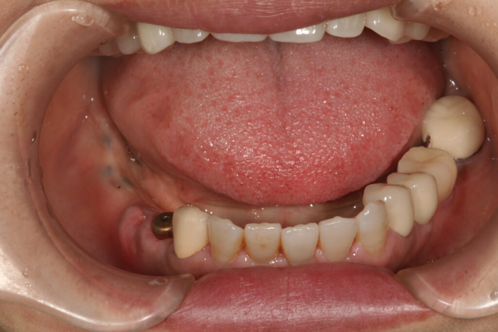 症例紹介｜インプラント｜佐賀｜船津歯科クリニック