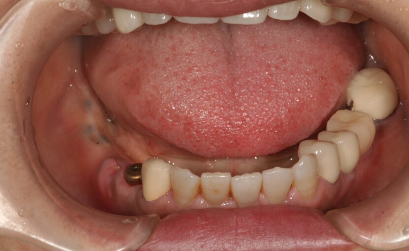 症例紹介｜インプラント｜佐賀｜船津歯科クリニック