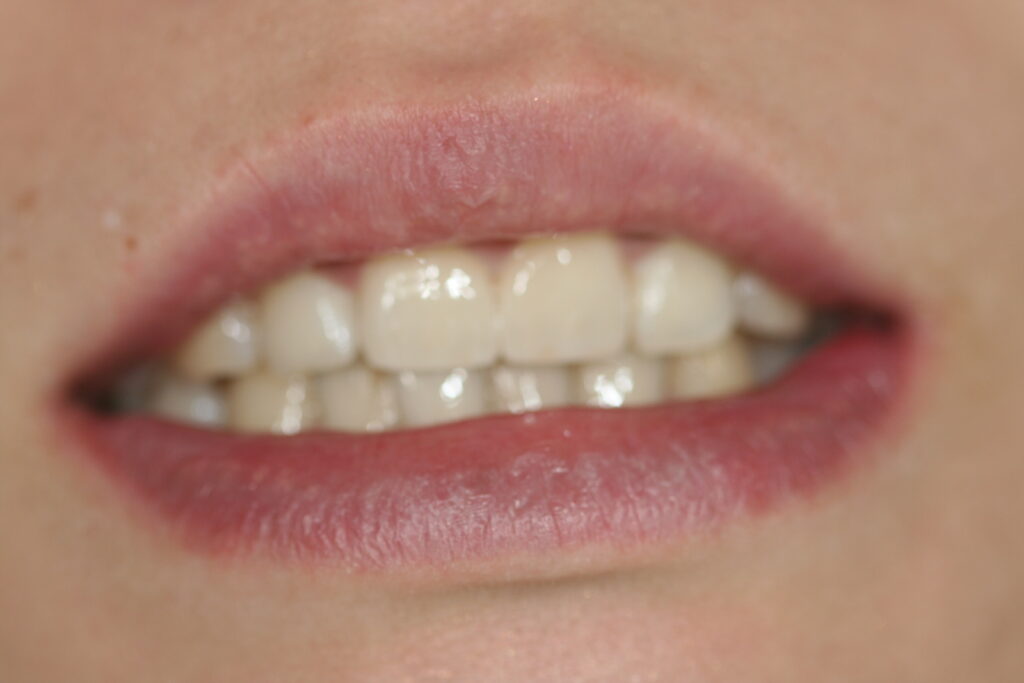 症例紹介｜審美歯科｜佐賀｜船津歯科クリニック