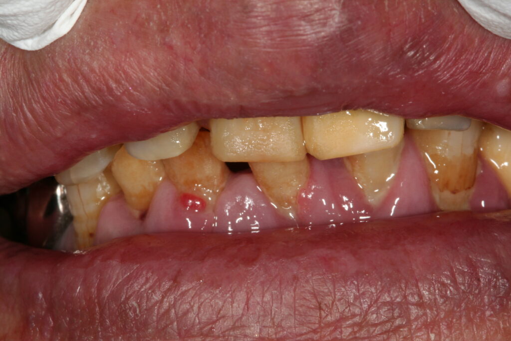 症例紹介｜審美歯科｜佐賀｜船津歯科クリニック