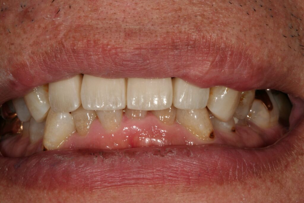 症例紹介｜審美歯科｜佐賀｜船津歯科クリニック