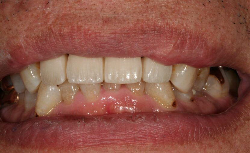 症例紹介｜審美歯科｜佐賀｜船津歯科クリニック