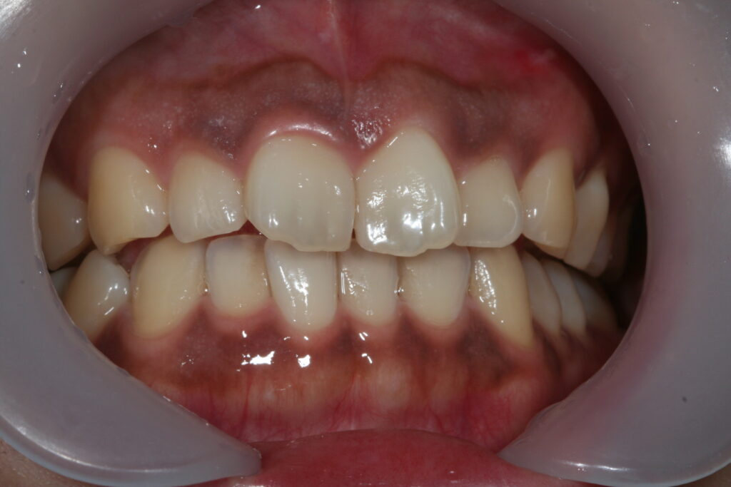 症例紹介｜審美歯科｜佐賀｜船津歯科クリニック