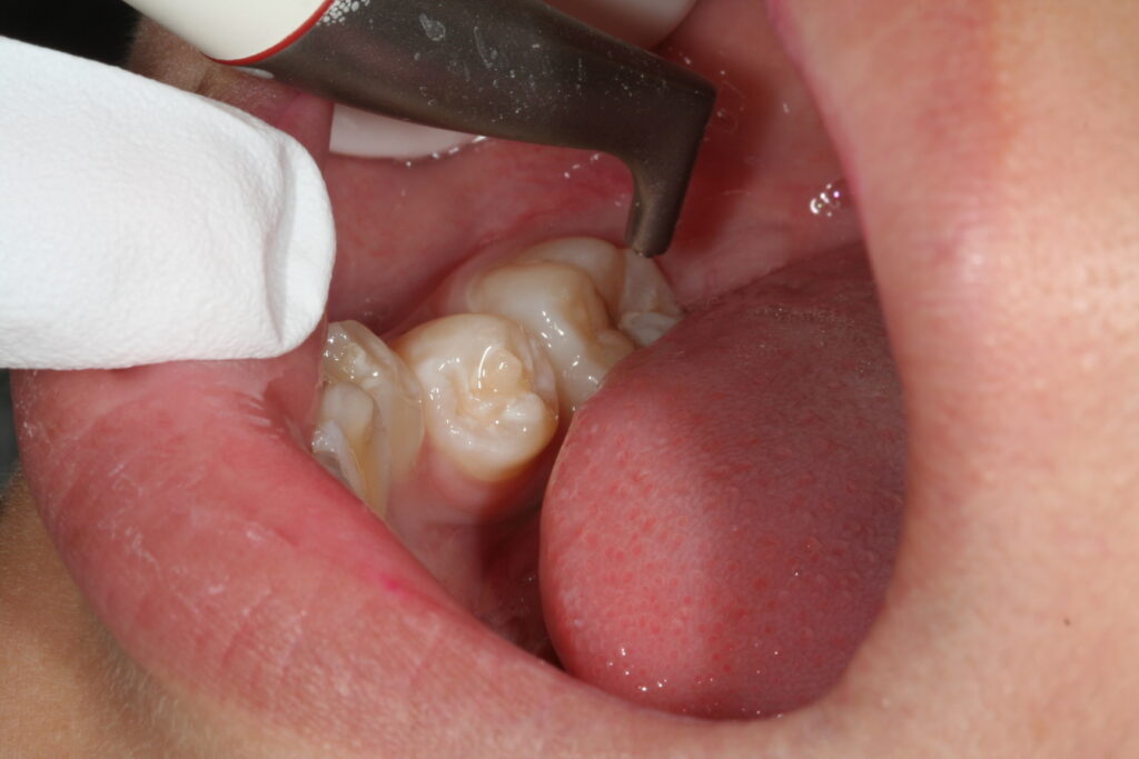 症例紹介｜虫歯治療｜佐賀｜船津歯科クリニック