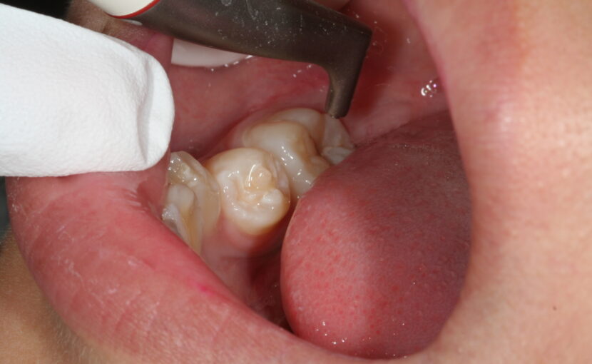 症例紹介｜虫歯治療｜佐賀｜船津歯科クリニック