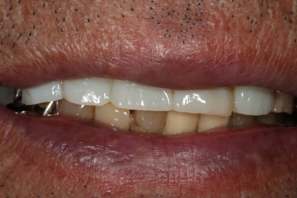 症例紹介｜ホワイトニング｜佐賀｜船津歯科クリニック