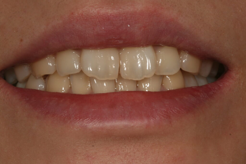 症例紹介｜審美歯科｜佐賀｜船津歯科クリニック