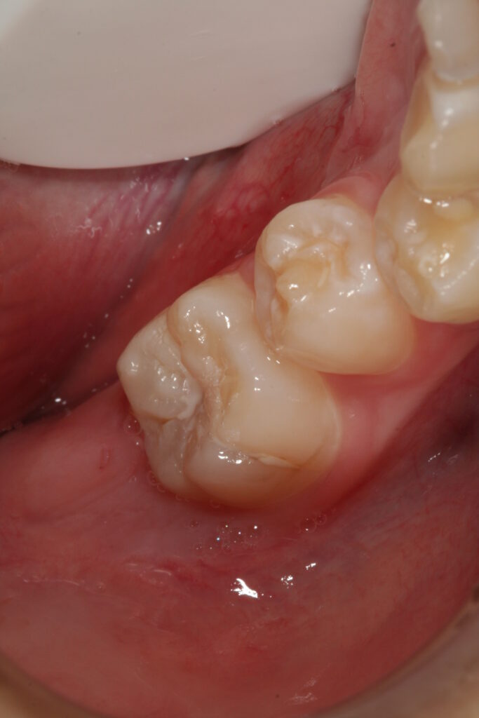 症例紹介｜虫歯治療｜佐賀｜船津歯科クリニック
