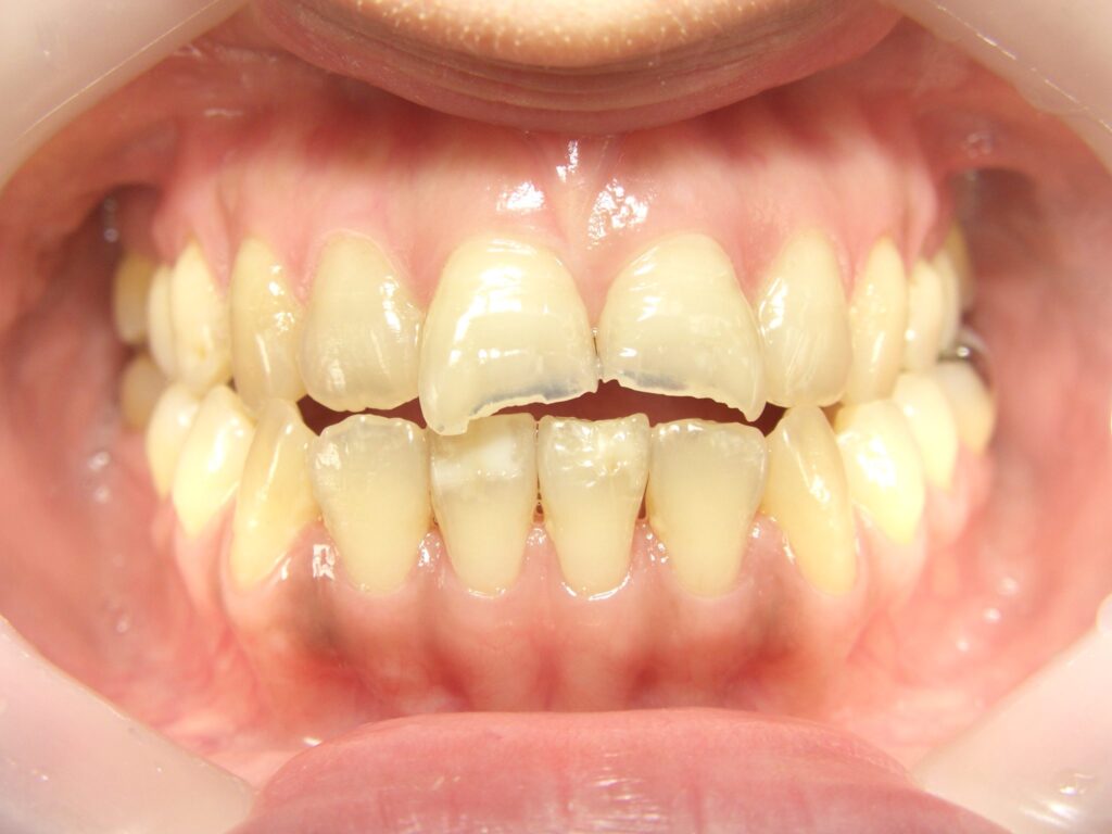 症例紹介｜審美歯科｜佐賀｜船津歯科クリニック