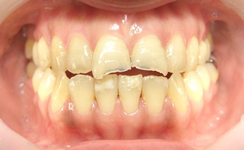 症例紹介｜審美歯科｜佐賀｜船津歯科クリニック