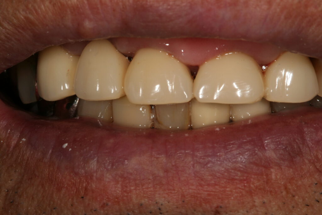 症例紹介｜ホワイトニング｜佐賀｜船津歯科クリニック