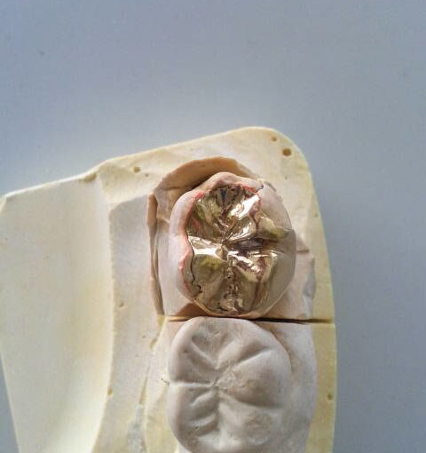 症例紹介｜奥歯の治療｜佐賀｜船津歯科クリニック