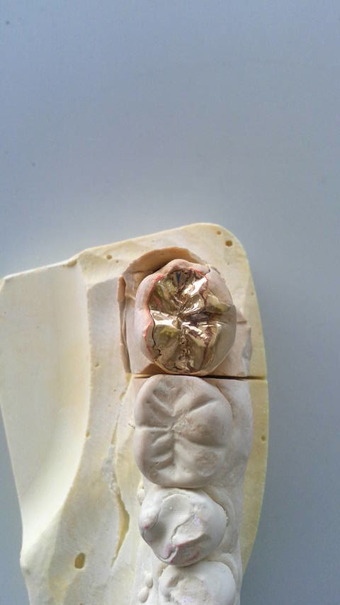 症例紹介｜奥歯の治療｜佐賀｜船津歯科クリニック