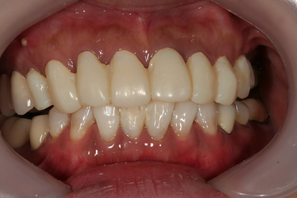 症例紹介｜審美歯科｜佐賀｜船津歯科クリニック