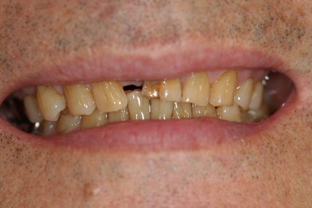 症例紹介｜審美歯科｜佐賀｜船津歯科クリニック