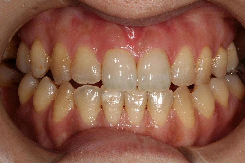 症例紹介｜審美歯科｜佐賀｜船津歯科クリニック