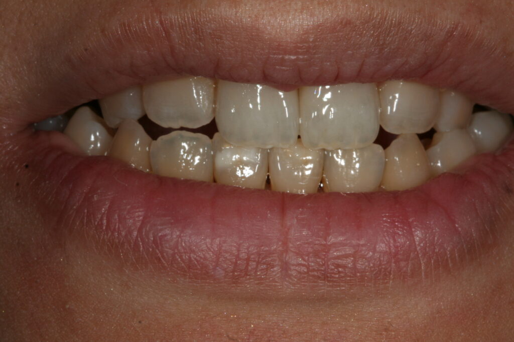 症例紹介｜審美歯科｜佐賀｜船津歯科クリニック