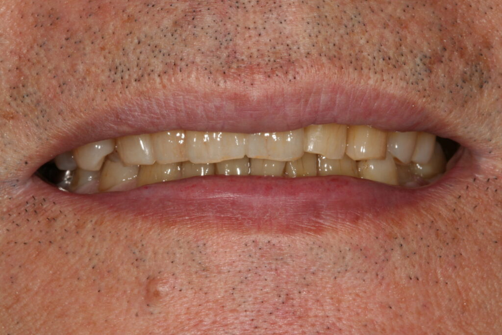 症例紹介｜審美歯科｜佐賀｜船津歯科クリニック