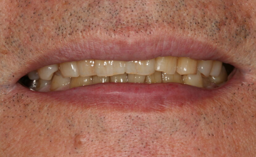 症例紹介｜審美歯科｜佐賀｜船津歯科クリニック