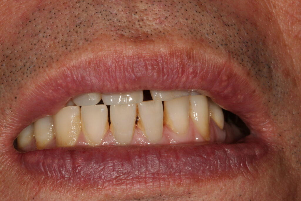 症例紹介｜審美歯科｜佐賀｜船津歯科クリニック