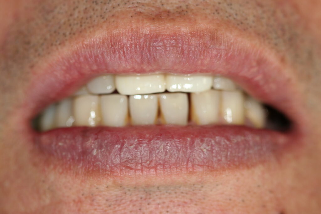 症例紹介｜審美歯科｜佐賀｜船津歯科クリニック