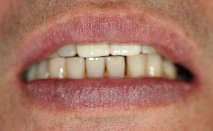 症例紹介｜審美歯科｜佐賀｜船津歯科クリニック