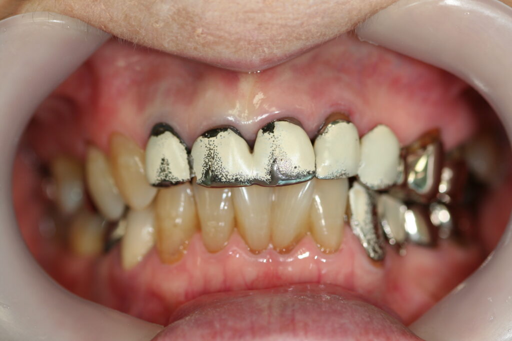 症例紹介｜審美歯科｜佐賀｜船津歯科クリニック