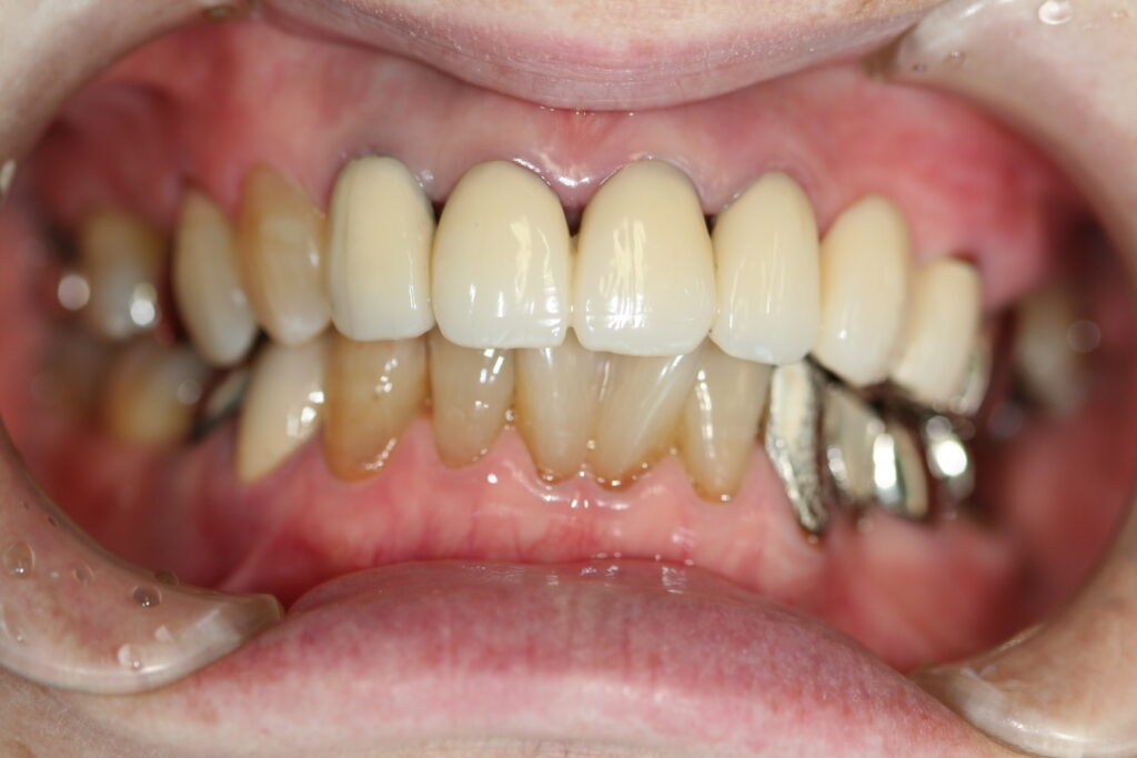 症例紹介｜審美歯科｜佐賀｜船津歯科クリニック